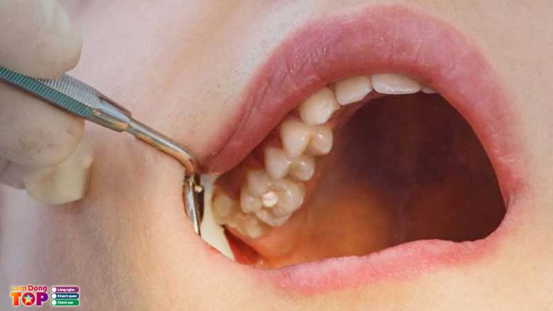 Nho-rang-khon-lam-dong-lamdongtoplist